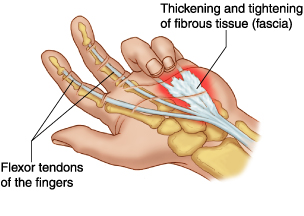 Dupuytren’s contracture involves thickening of fibrous bands (cords) of skin and underlying tissue in the palm (palmar fascia) that can result in the band shortening. As the bands contract, the fingers pull down into the palm (flexion contracture). The bands are so strong that the individual becomes unable to straighten his or her involved fingers. Dupuytren’s contracture is a hereditary disorder. Severity varies, with some individuals developing only nodules (bumps in palm) without the flexion contractures. —The Reed Group